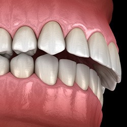 Illustration of an overbite