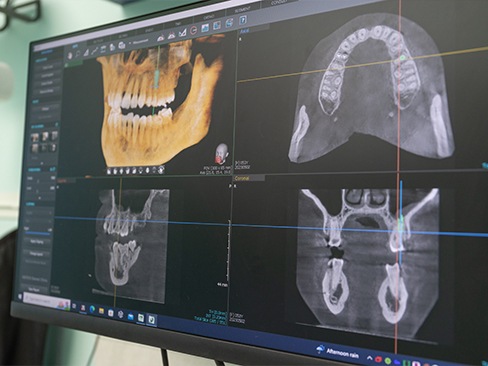 dentist showing a patient a model of how dental implants work in Garland 