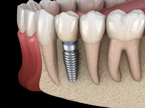 dental implant post in the jawbone 