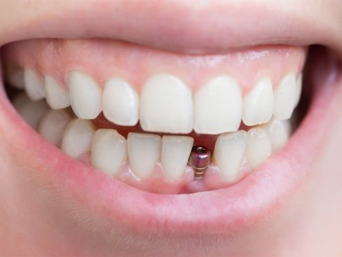person smiling with a dental implant abutment  
