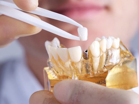 dentist placing a crown onto a model of a dental implant   