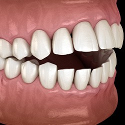 Illustration of an open bite