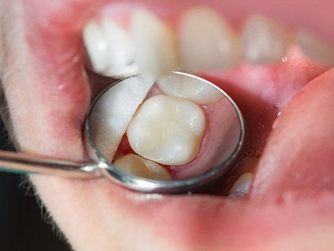 Closeup of smile repaired with tooth colored filling