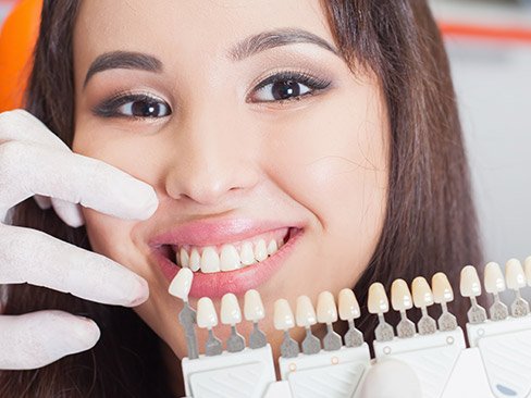 Woman's smile compared with porcelain veneer color chart