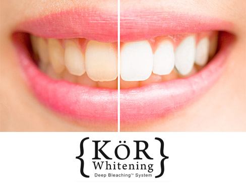 Closeup of smile half before and half after teeth whitening
