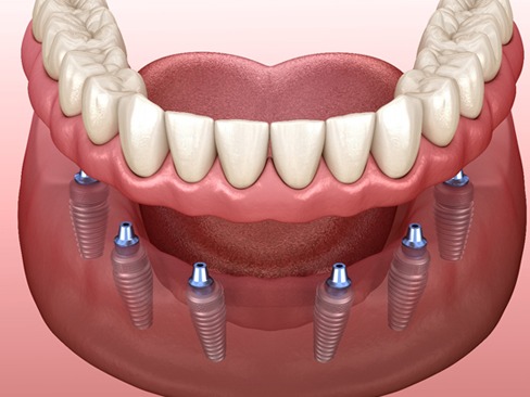 A dental implant-retained denture