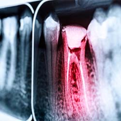 X-ray of a toothache in Garland