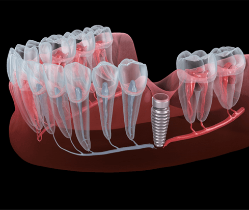 Render of a failed dental implant in Garland, TX