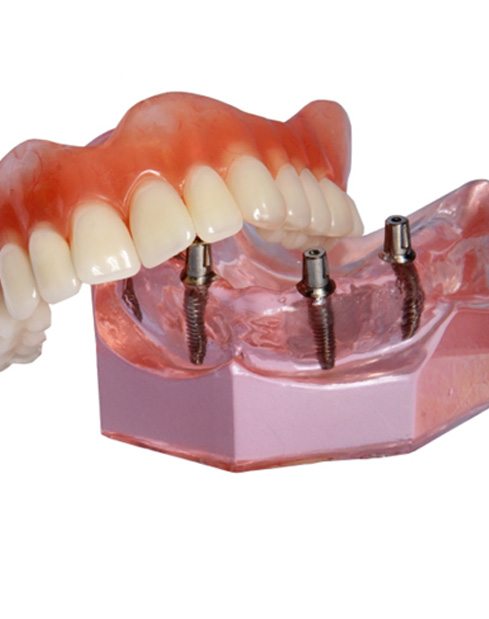 Model of an implant denture
