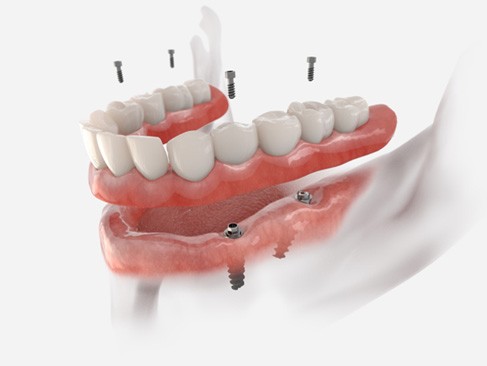 3D render of an implant denture