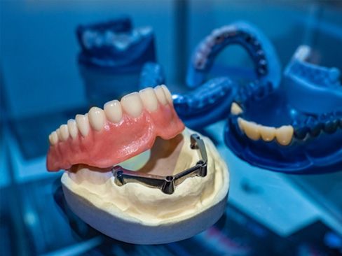 Model of an implant denture in a lab