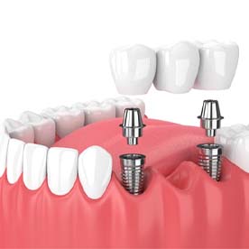 implant bridge illustration for cost of dental implants in Garland