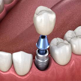 single dental implant with crown in the lower jaw