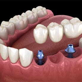 dental bridge being supported by two dental implants