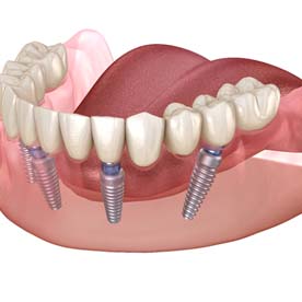 four dental implants holding a full denture in place