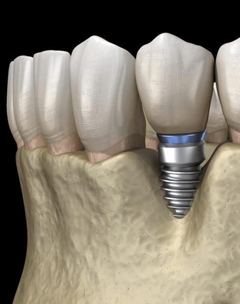 Bone loss around a failed dental implant in Garland, TX