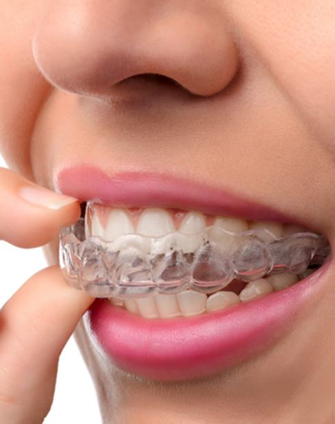 Woman placing an Invisalign tray