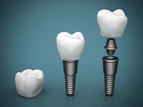 Animated dental implant supported restoration process