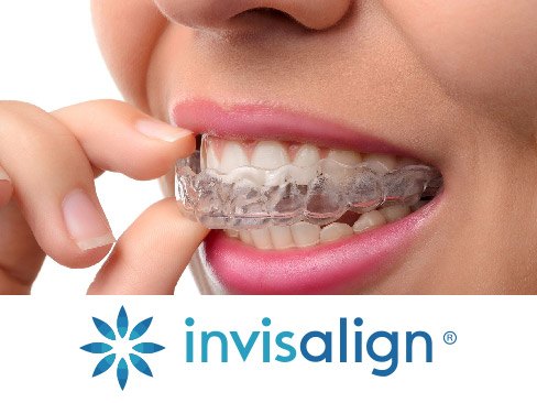 Closeup of patient placing Invisalign tray