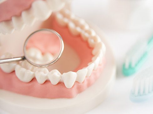 Model smile demonstrating need for periodontal maintenance