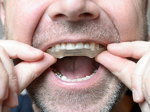 Closeup of patient placing nightguard for bruxism