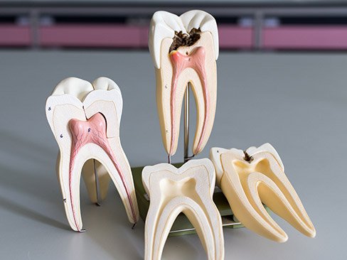 Models of the inside of a healthy tooth and tooth in need of root canal therapy