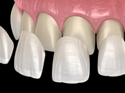 veneers being placed over the teeth  