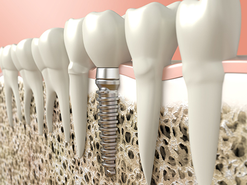 Digital illustration of a dental implant