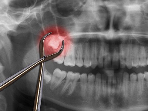 X-ray of impacted wisdom tooth