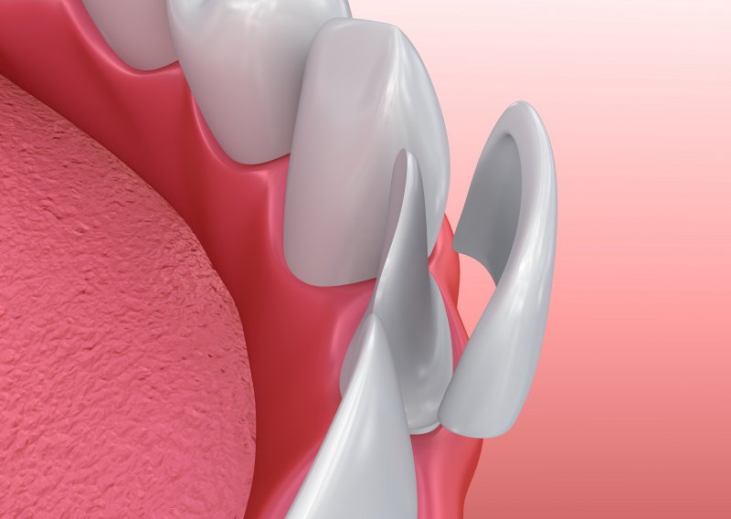 3D illustration of veneers in Garland