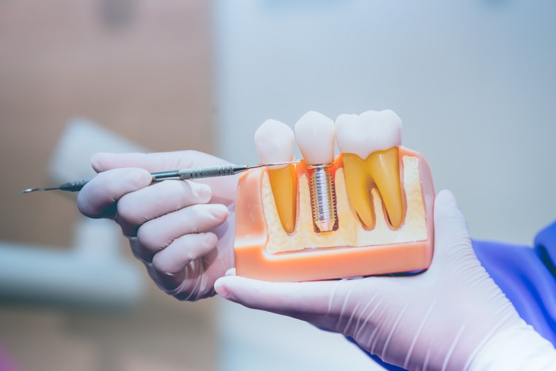 A dentist holding an enlarged dental implant model