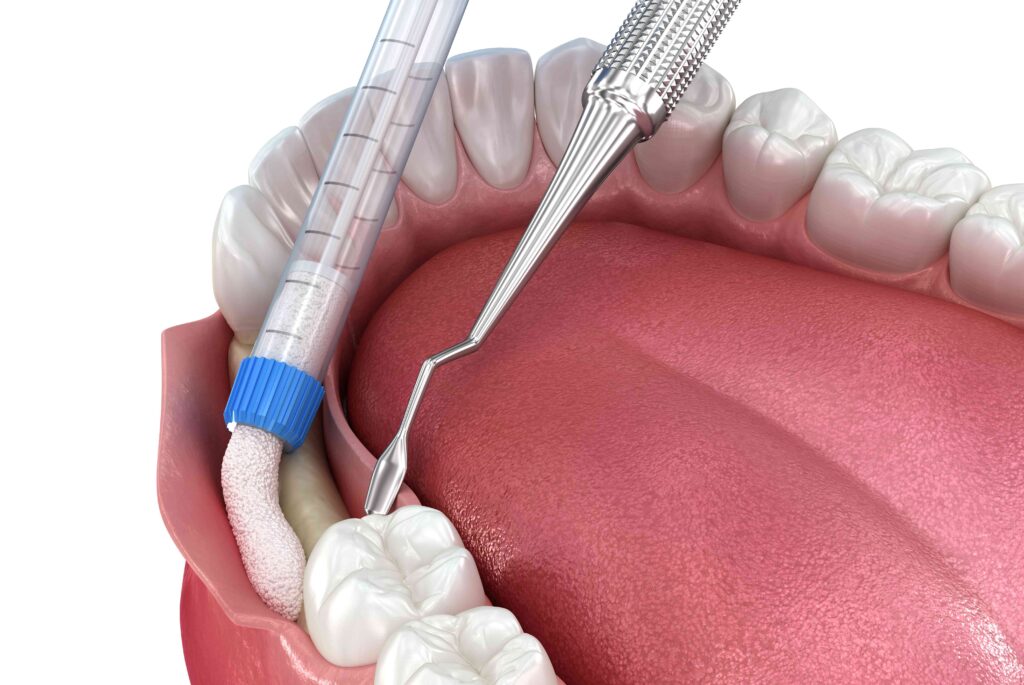 Digital illustration of a bone graft