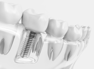 Illustration of dental implant in plastic model