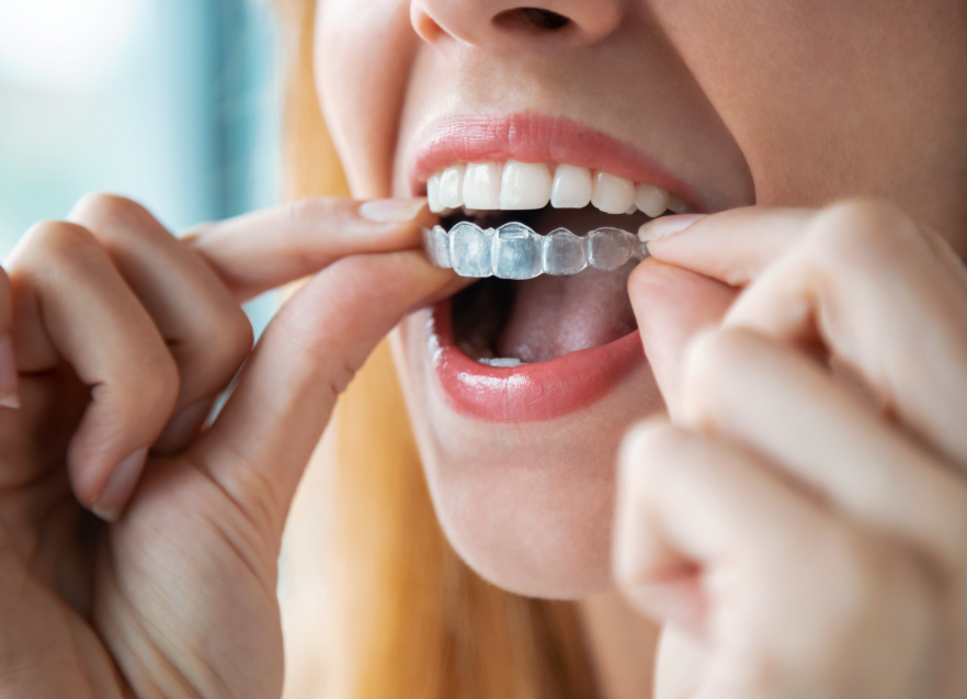 Woman putting on clear aligner